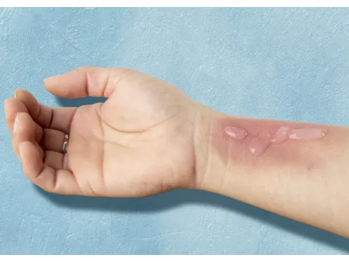 Burn Care Gel Voor Brandwonden Flacon van 118ml